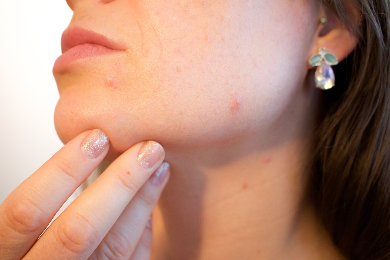 acne pores skin pimple female 1606765